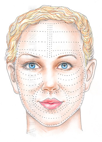 Уколы с гиалуроновой кислотой для лица. Фото результатов инъекций под глаза, противопоказания
